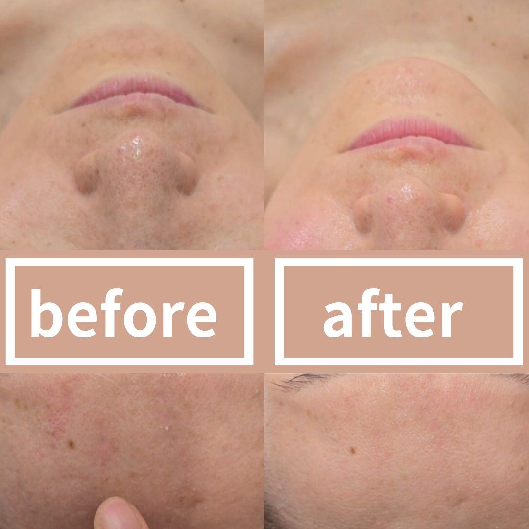 【最新版】『ララピール504成分入り』１箱ベーシック▪︎ウルトラ各1本韓国No1